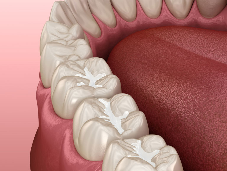 Is Dental Sealant Treatment Right for You?