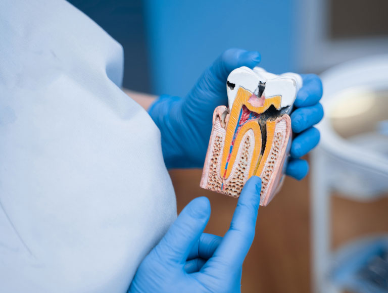Root Canal Therapy