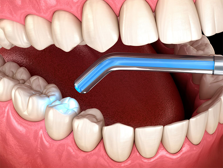 Dental Fillings